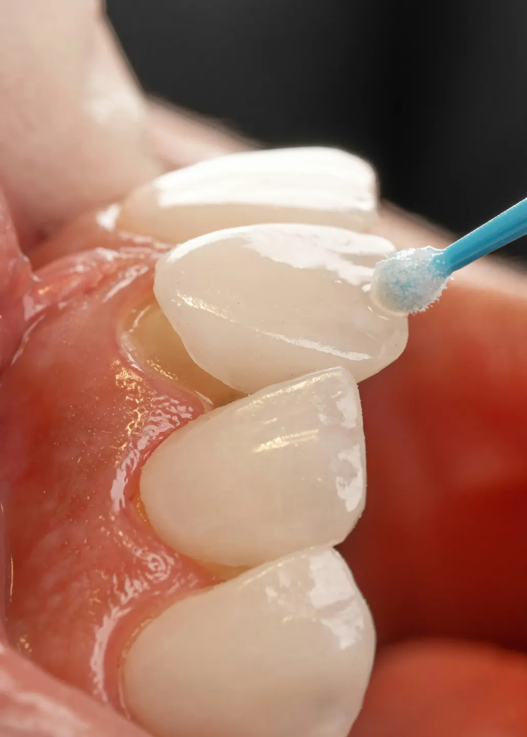 Porcelain Veneers
